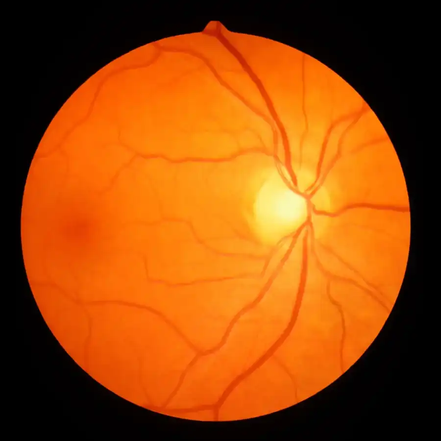 Retinal imaging used during diabetic eye exams in Syracuse, Utah